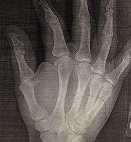Broken Hand X-Ray